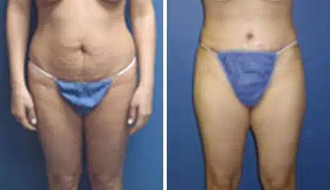 Tummy Tuck Before and After Photos in New York, NY, Patient 10552