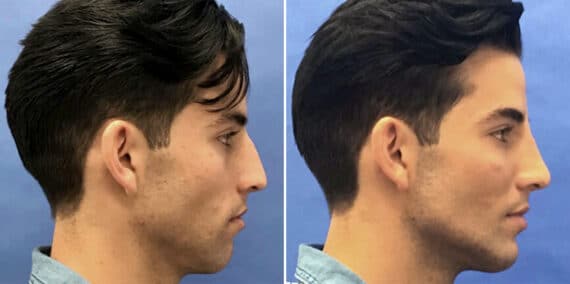 Male Model Make Over Before and After Photos in New York, NY, Patient 16243