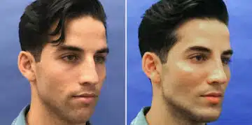 Male Model Make Over Before and After Photos in New York, NY, Patient 16243