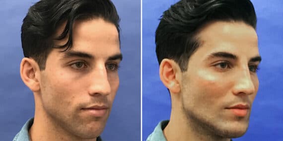 Male Model Make Over Before and After Photos in New York, NY, Patient 16243