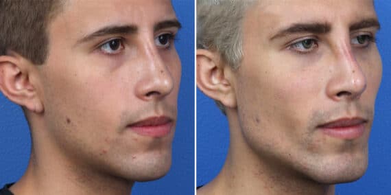 Male Model Make Over Before and After Photos in New York, NY, Patient 16250
