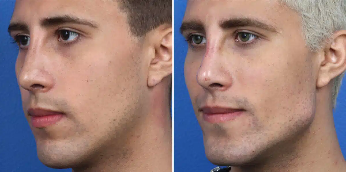 Male Model Make Over Before and After Photos in New York, NY, Patient 16250