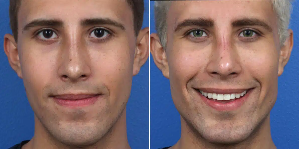 Male Model Make Over Before and After Photos in New York, NY, Patient 16250