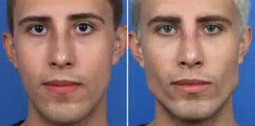 Male Model Make Over Before and After Photos in New York, NY, Patient 16250