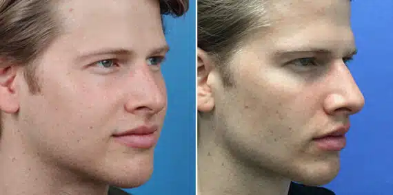 Male Model Make Over Before and After Photos in New York, NY, Patient 16281
