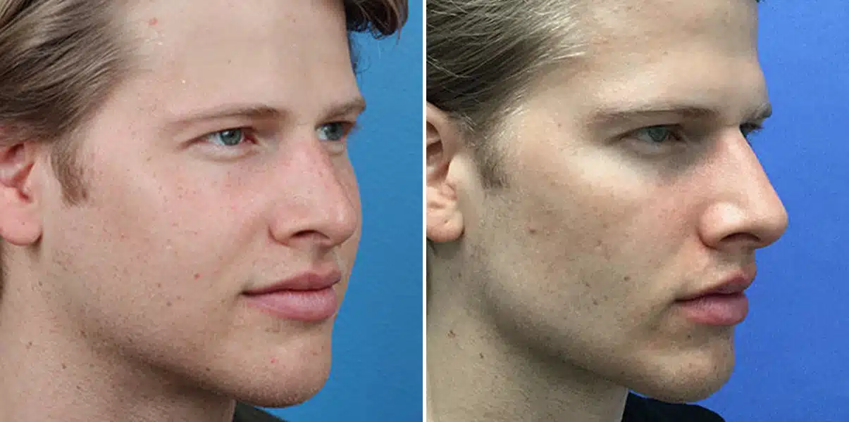 Male Model Make Over Before and After Photos in New York, NY, Patient 16281