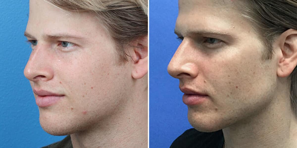 Male Model Make Over Before and After Photos in New York, NY, Patient 16281
