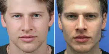 Male Model Make Over Before and After Photos in New York, NY, Patient 16281