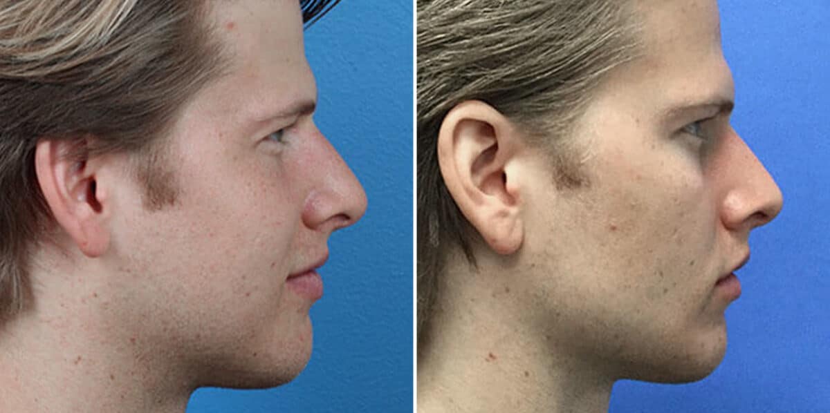 Male Model Make Over Before and After Photos in New York, NY, Patient 16281