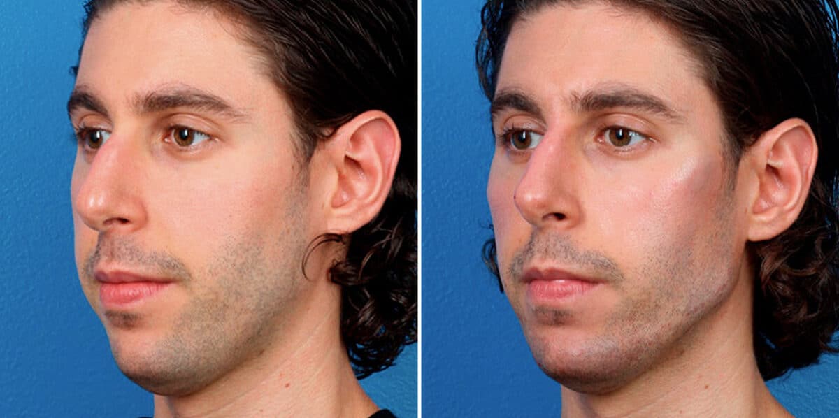 Male Model Make Over Before and After Photos in New York, NY, Patient 17219