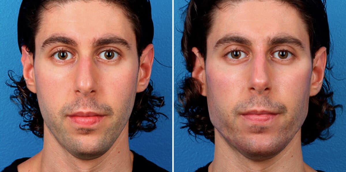 Male Model Make Over Before and After Photos in New York, NY, Patient 17219