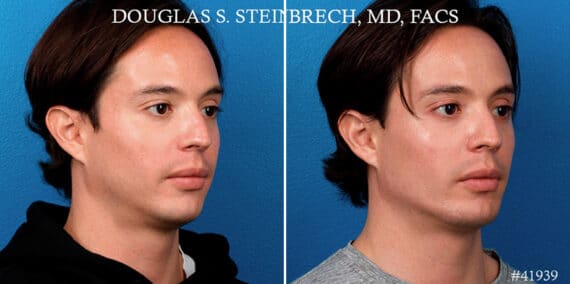 Male Model Make Over Before and After Photos in New York, NY, Patient 17365