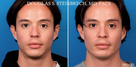 Male Model Make Over Before and After Photos in New York, NY, Patient 17365