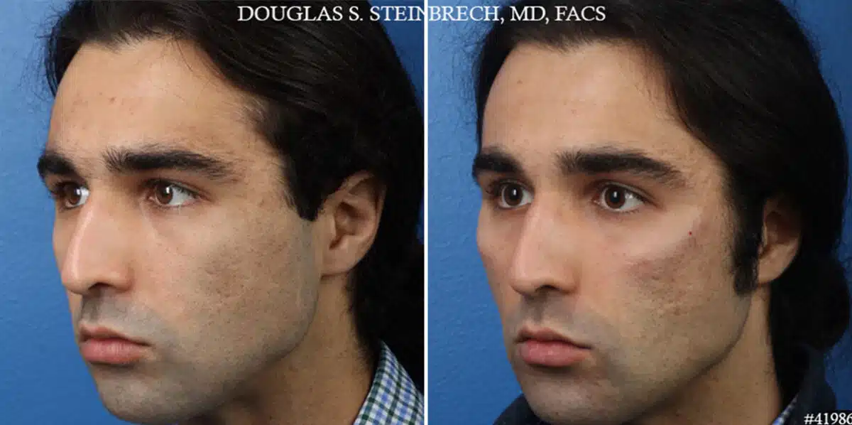 Male Model Make Over Before and After Photos in CA, Beverly Hills, Patient 19249