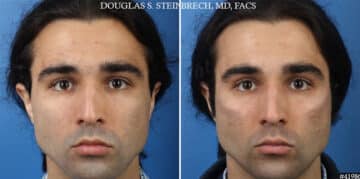 Male Model Make Over Before and After Photos in CA, Beverly Hills, Patient 19249