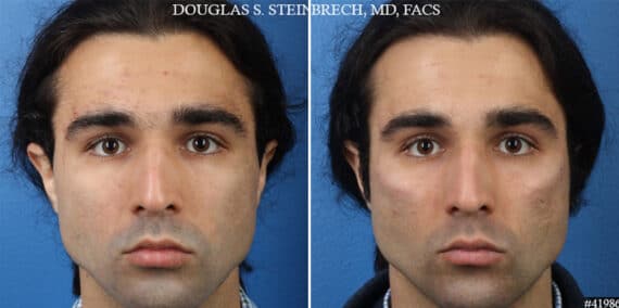 Male Model Make Over Before and After Photos in CA, Beverly Hills, Patient 19249