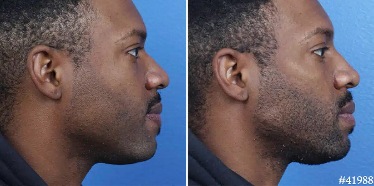 Male Model Make Over Before and After Photos in New York, NY, Patient 19508