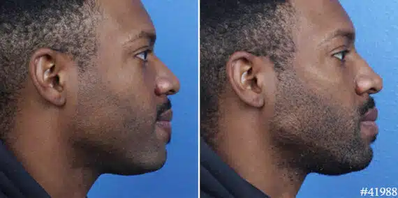 Male Model Make Over Before and After Photos in New York, NY, Patient 19508