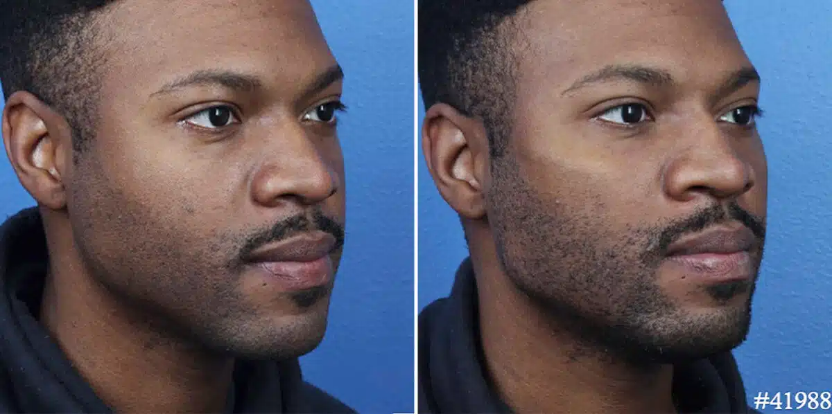 Male Model Make Over Before and After Photos in New York, NY, Patient 19508