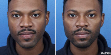 Male Model Make Over Before and After Photos in New York, NY, Patient 19508