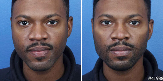 Male Model Make Over Before and After Photos in New York, NY, Patient 19508