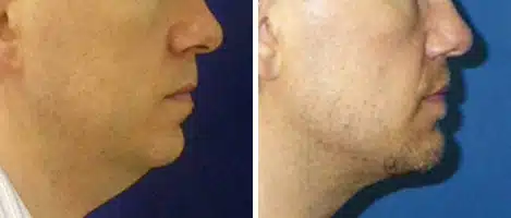 Neck Liposuction Before and After Photos in New York, NY, Patient 12685