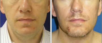 Neck Liposuction Before and After Photos in New York, NY, Patient 12685