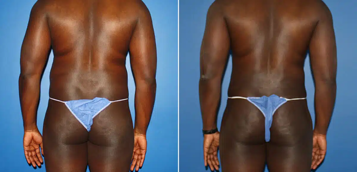 Body Banking Before and After Photos in New York, NY, Patient 16006
