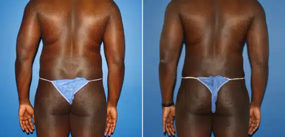 Liposuction Before and After Photos in New York, NY, Patient 16006