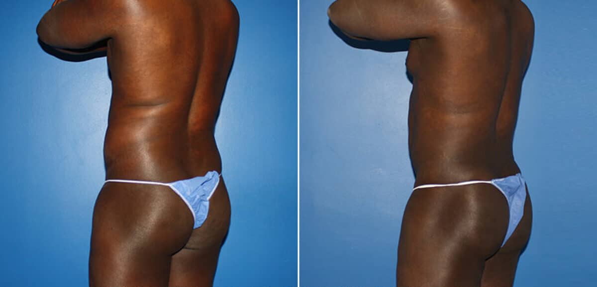 Body Banking Before and After Photos in New York, NY, Patient 16006