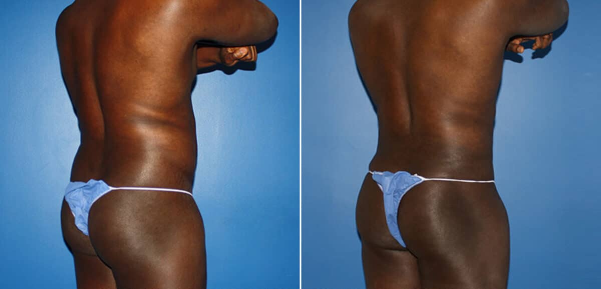Body Banking Before and After Photos in New York, NY, Patient 16006