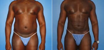 Liposuction Before and After Photos in New York, NY, Patient 16006