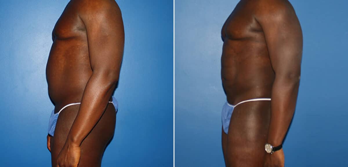 Body Banking Before and After Photos in New York, NY, Patient 16006