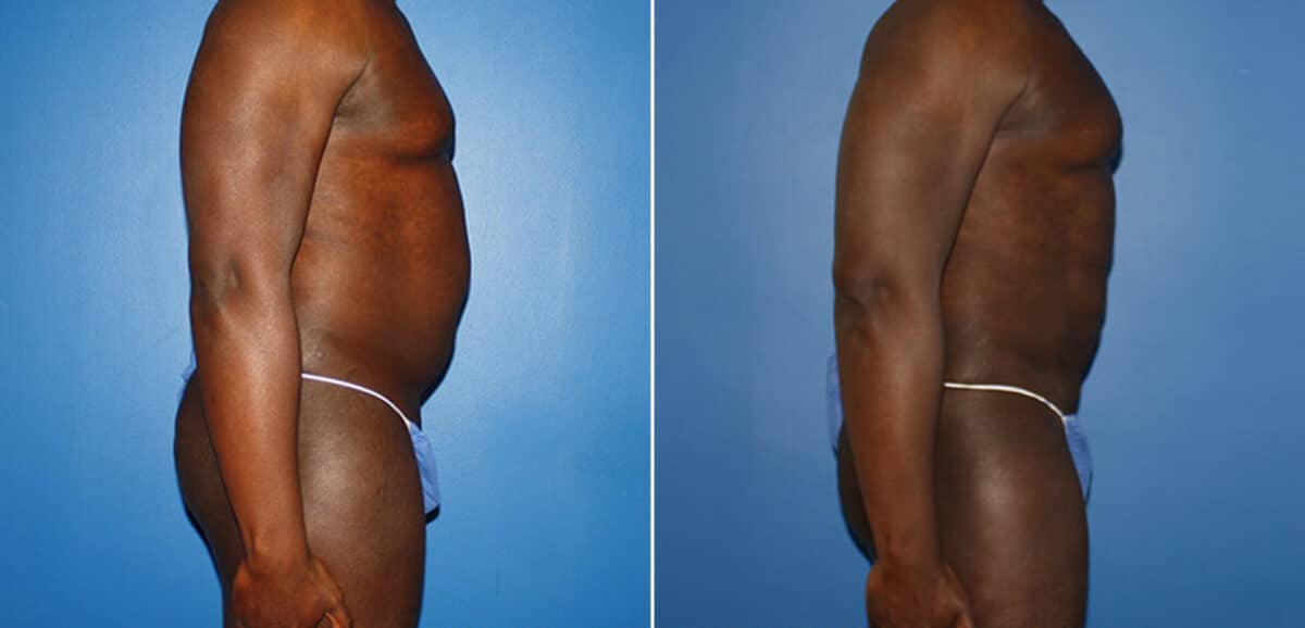 Body Banking Before and After Photos in New York, NY, Patient 16006