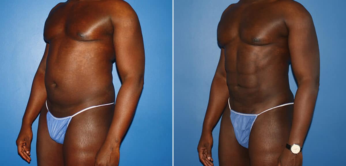 Body Banking Before and After Photos in New York, NY, Patient 16006
