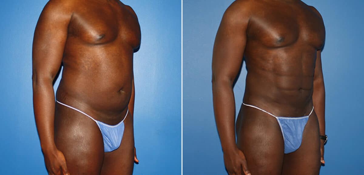 Body Banking Before and After Photos in New York, NY, Patient 16006