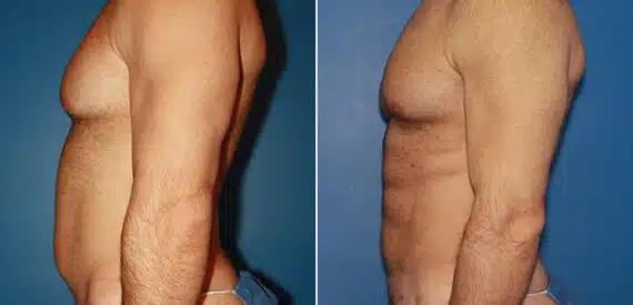 Gladiator Abs Before and After Photos in New York, NY, Patient 16051
