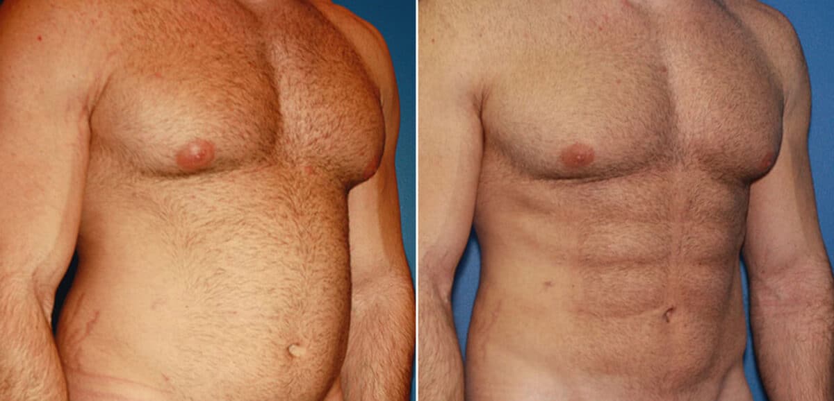 Gladiator Abs Before and After Photos in New York, NY, Patient 16051