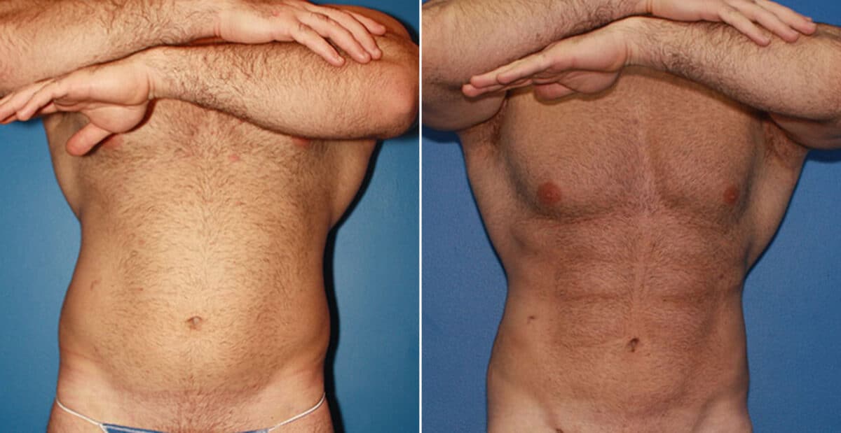 Gladiator Abs Before and After Photos in New York, NY, Patient 16051