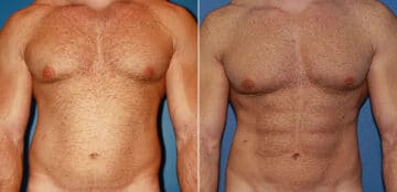 Gladiator Abs Before and After Photos in New York, NY, Patient 16051