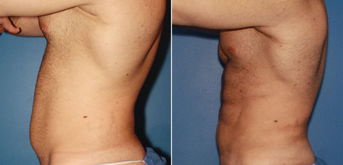 Gladiator Abs Before and After Photos in New York, NY, Patient 16051