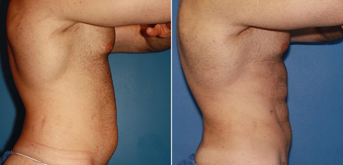Gladiator Abs Before and After Photos in New York, NY, Patient 16051