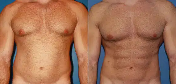 Gladiator Abs Before and After Photos in New York, NY, Patient 16051