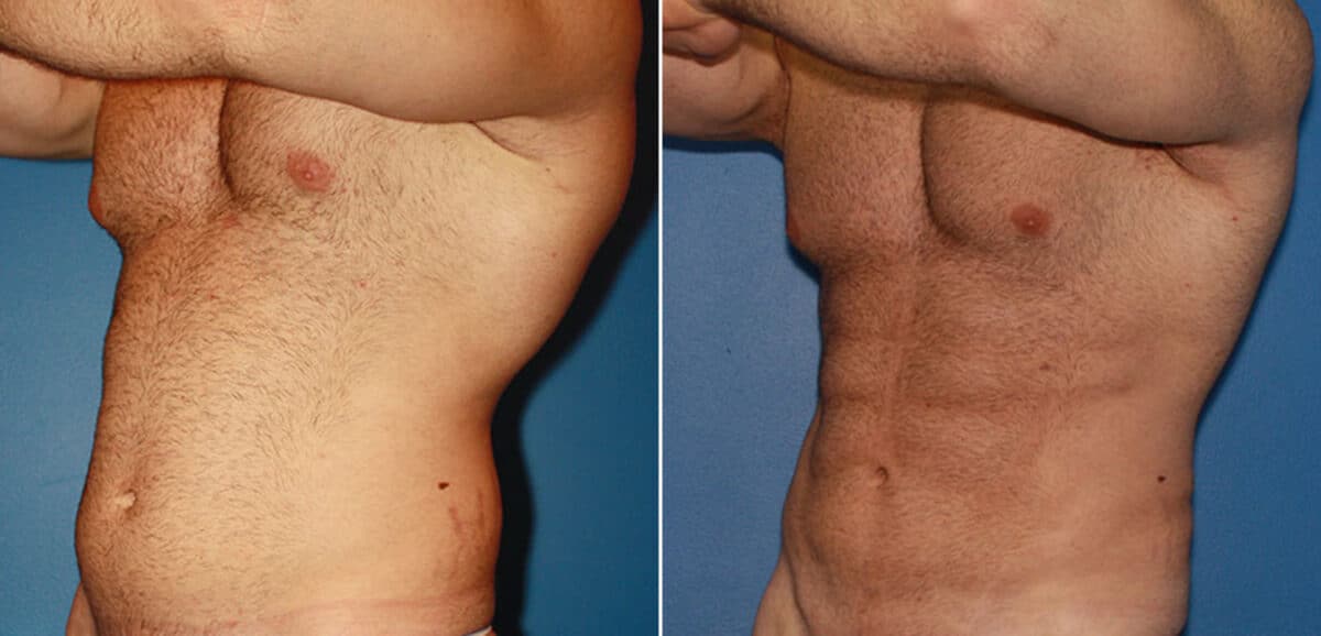 Gladiator Abs Before and After Photos in New York, NY, Patient 16051
