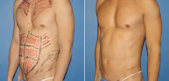 Body Banking Before and After Photos in New York, NY, Patient 16188