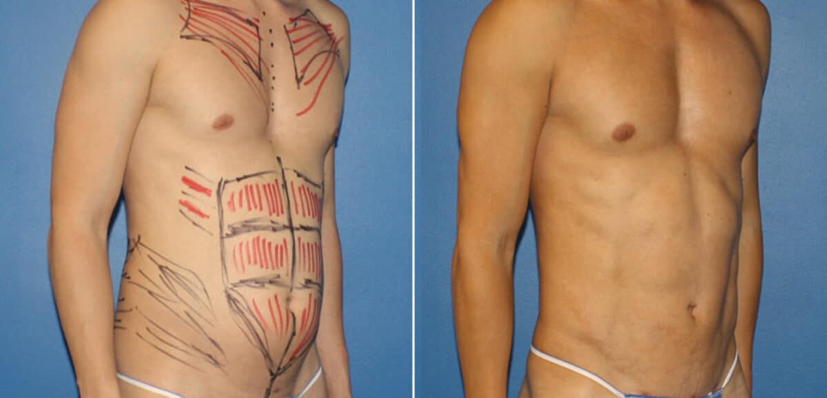 Body Banking Before and After Photos in New York, NY, Patient 16188