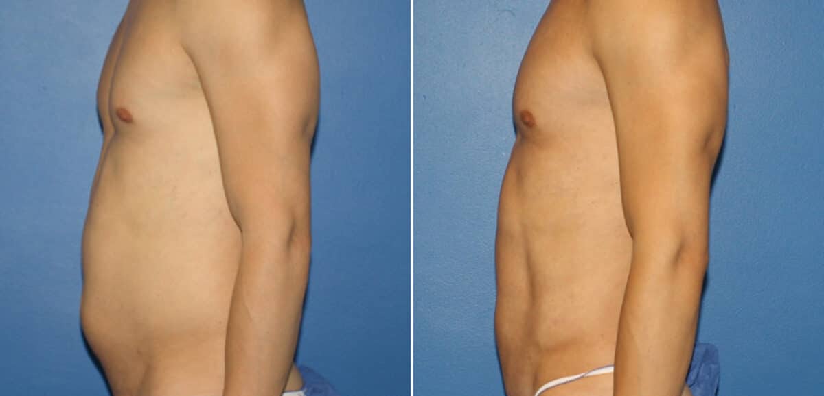 Body Banking Before and After Photos in New York, NY, Patient 16188
