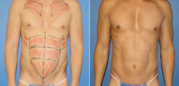 Body Banking Before and After Photos in New York, NY, Patient 16188