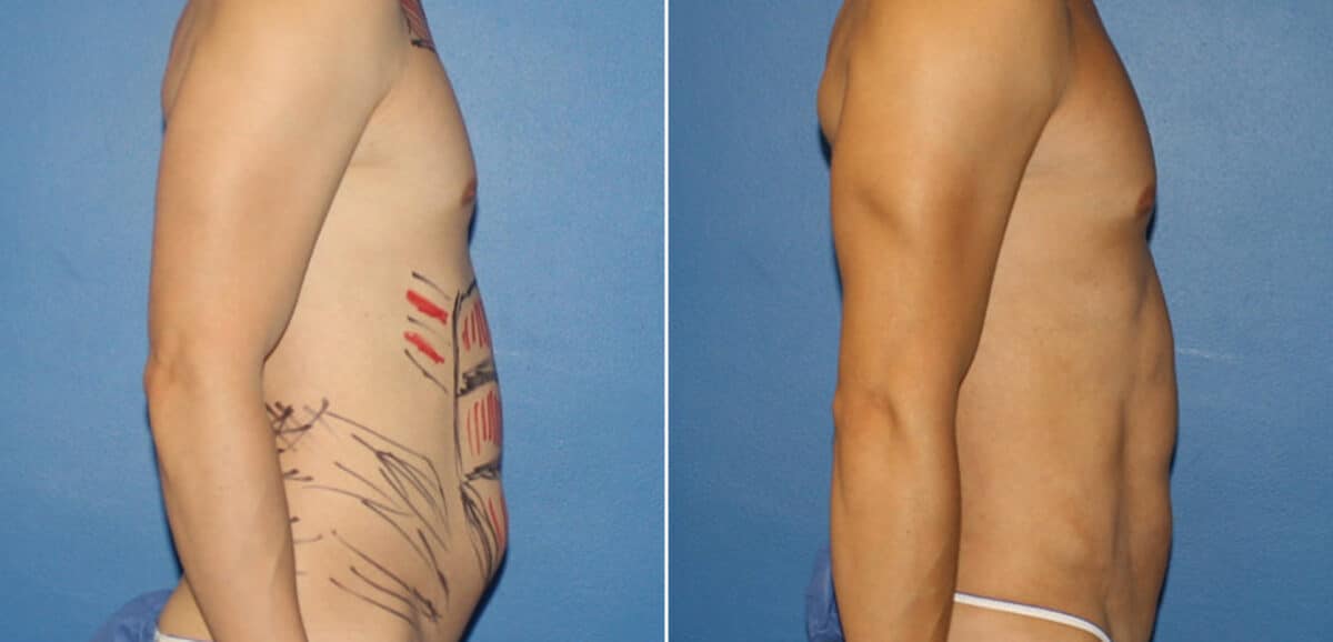 Body Banking Before and After Photos in New York, NY, Patient 16188
