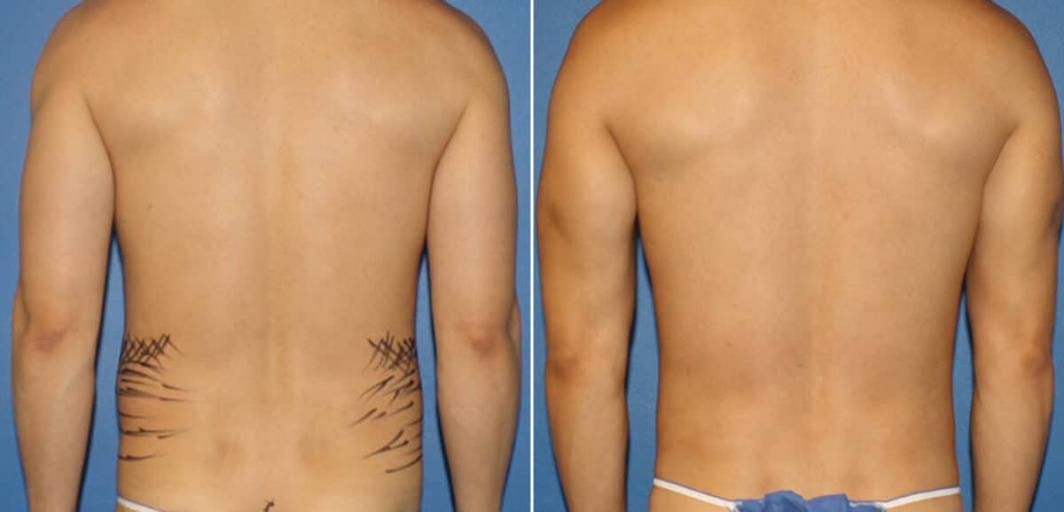 Body Banking Before and After Photos in New York, NY, Patient 16188